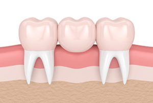 Dental Bridge
